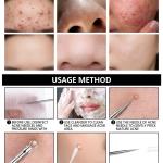 4Pcs Blackhead Acne Removal Needle Cleaning Tool.