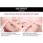 4PCS Blackhead Acne Removal Needle Cleaning Tool