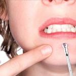 4pcs Dark Spot And Pimple Removing