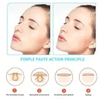 36 Patch Face Acne Pimple Patch - Pack of 1