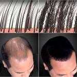 Hair Building Fibers For Thinning Hair Dark Brown For Both Men And Women (pack of 1).