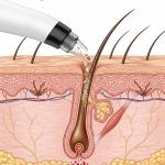 4-in-1 Blackhead Remover Tool and Pore Cleaning Facial Cleanser Vacuum System 1Pcs