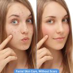6 Pcs Stainless Steel Blackhead Whitehead  Pimple Remover